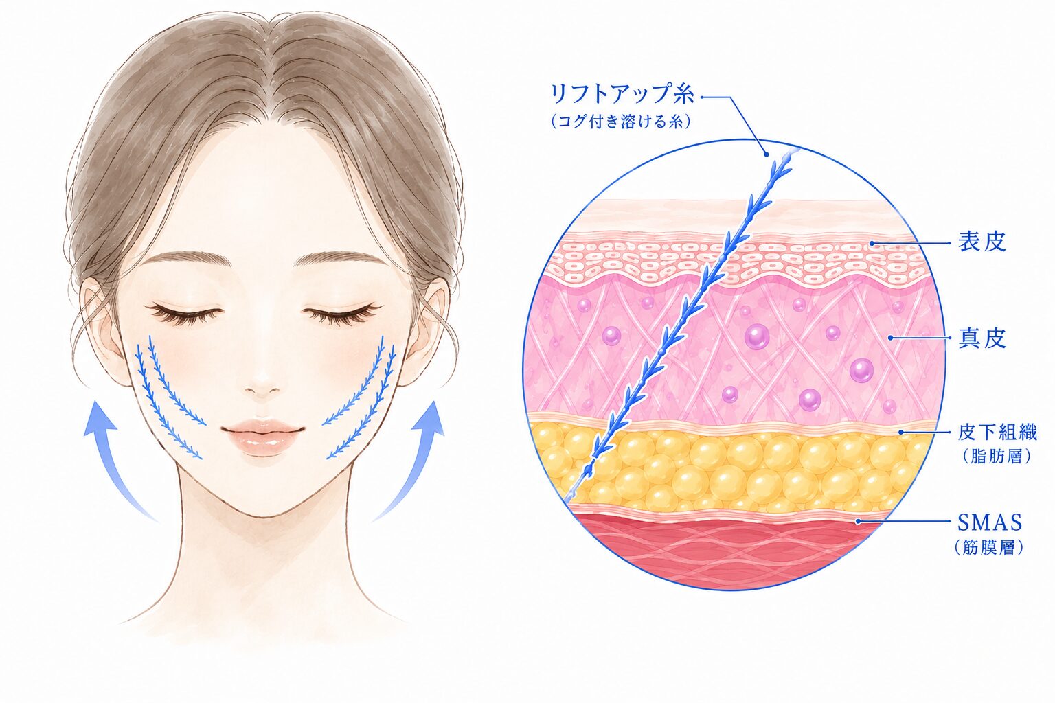 糸リフト