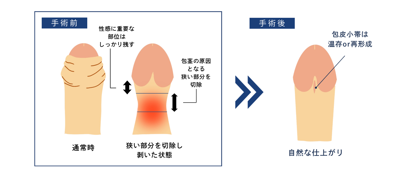 亀頭下環状切開法の手術説明図